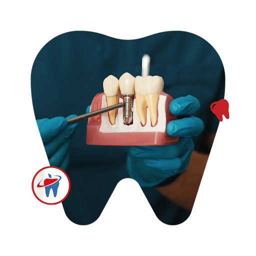 Planning a Teeth Implant After Tooth Loss: What to Expect